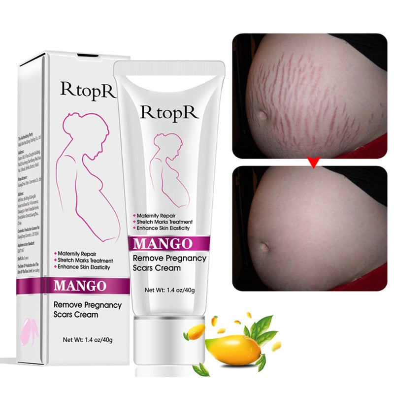 Mango remove pregnancy scars acne cream